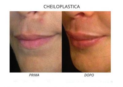 Aumento Volume Labbra Cheiloplastica