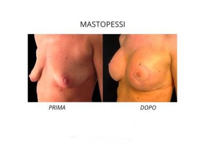 Mastopessi - lifting del seno