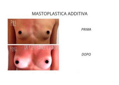 Mastoplastica Additiva - intervento al seno