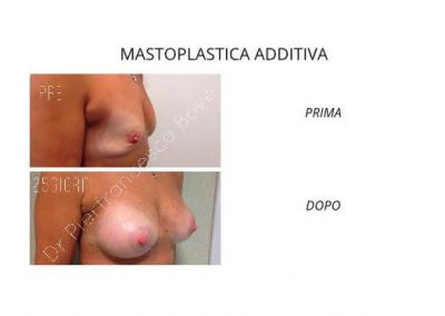 Mastoplastica Additiva - aumento seno